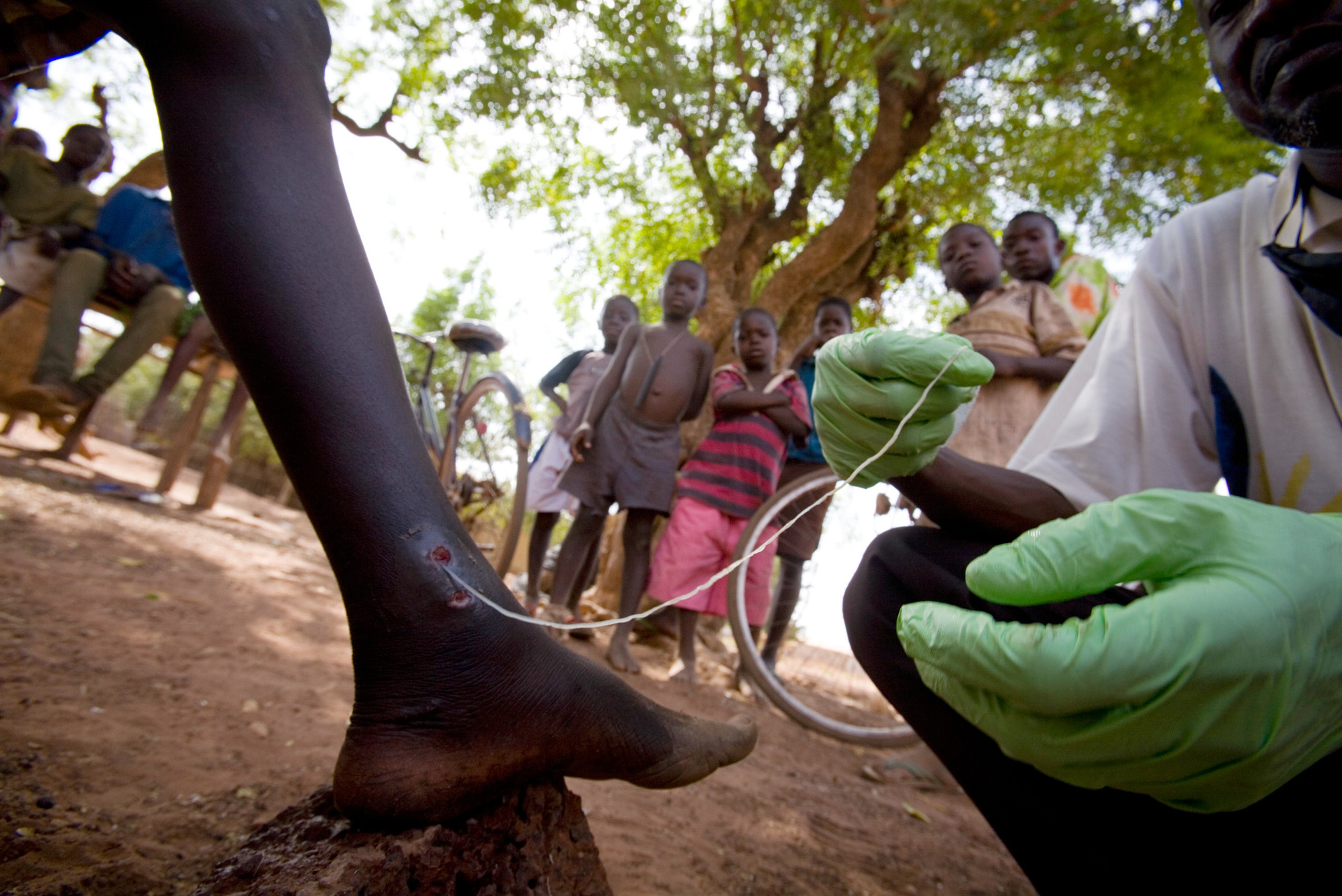 the-last-days-of-guinea-worm-colorado-public-radio