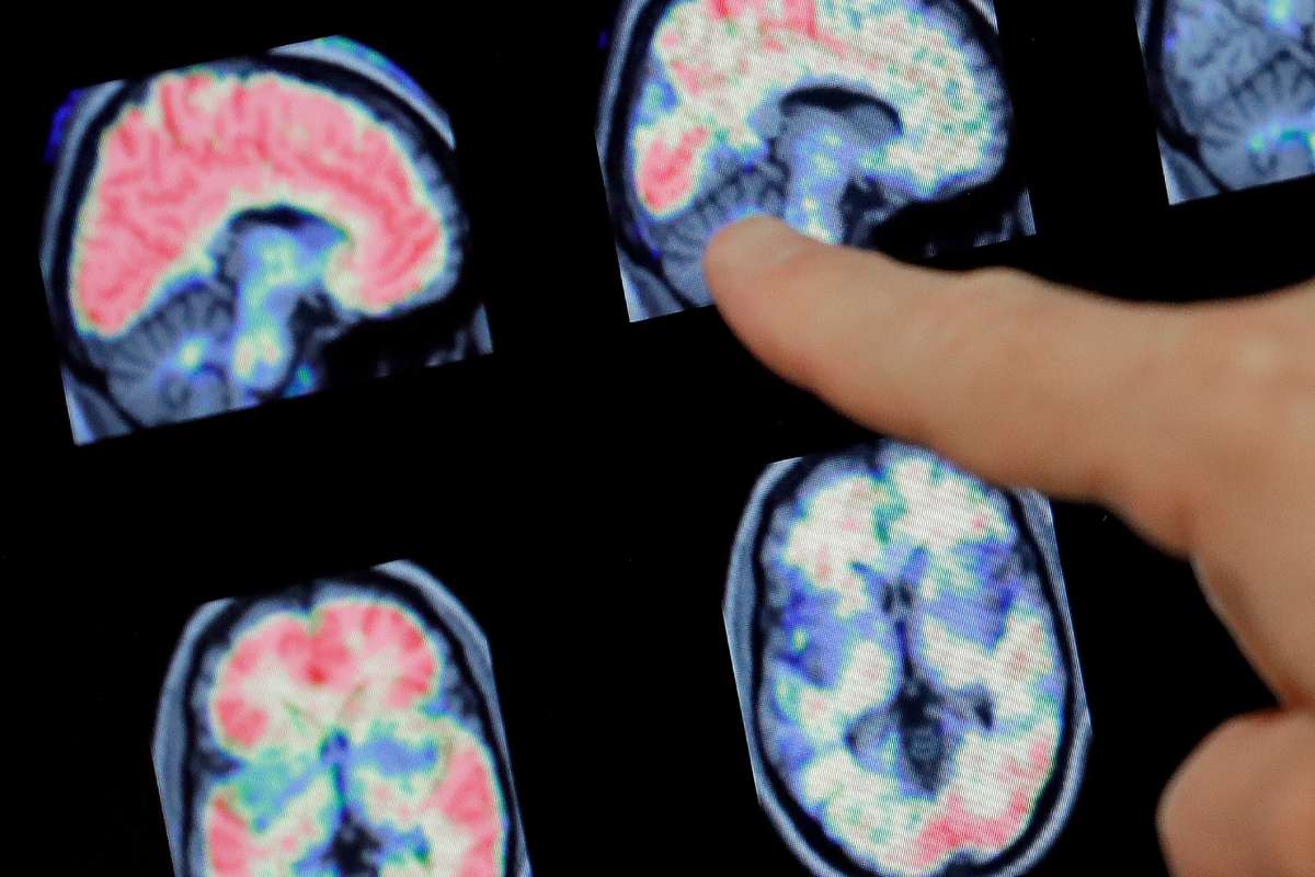 Colorado scientists say the drug Leukine halts brain cell loss in patients with Alzheimer’s and could improve cognition